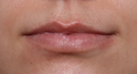 Lip Filler Before & After Patient #30050