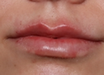 Lip Filler Before & After Patient #30050