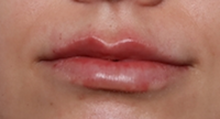Lip Filler Before & After Patient #30050