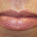 Lip Filler Before & After Patient #30055