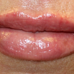 Lip Filler Before & After Patient #30055