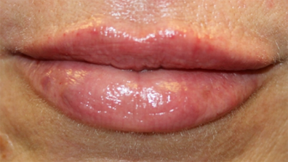 Lip Filler Before & After Patient #30055