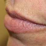 Lip Filler Before & After Patient #30055