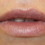 Lip Filler Before & After Patient #30123