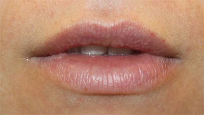 Lip Filler Before & After Patient #30123