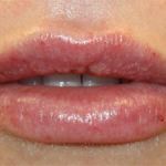 Lip Filler Before & After Patient #30123