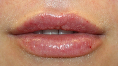 Lip Filler Before & After Patient #30123