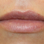 Lip Filler Before & After Patient #30123