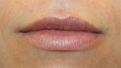 Lip Filler Before & After Patient #30123