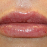 Lip Filler Before & After Patient #30123