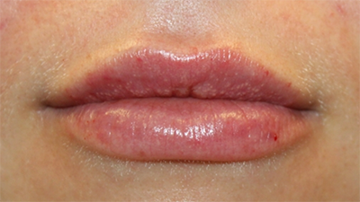 Lip Filler Before & After Patient #30123