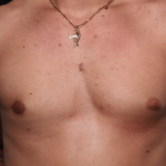 Gynecomastia Before & After Patient #30171