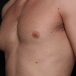 Gynecomastia Before & After Patient #30171