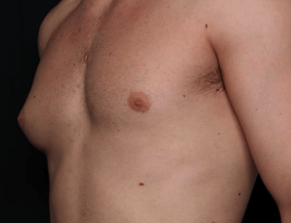 Gynecomastia Before & After Patient #30171