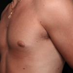 Gynecomastia Before & After Patient #30171