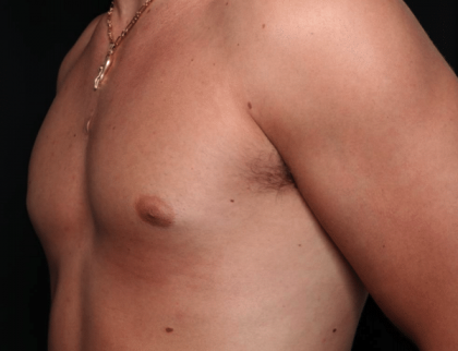 Gynecomastia Before & After Patient #30171