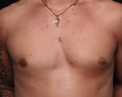 Gynecomastia Before & After Patient #30171