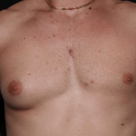 Gynecomastia Before & After Patient #30171