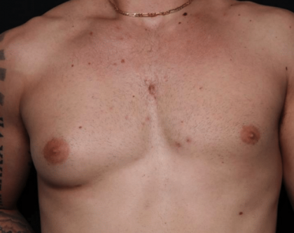 Gynecomastia Before & After Patient #30171