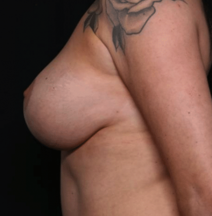 Breast Lift Before & After Patient #30129