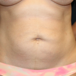 Tummy Tuck Before & After Patient #30015