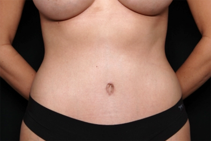 Tummy Tuck Before & After Patient #30015
