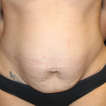 Tummy Tuck Before & After Patient #30027