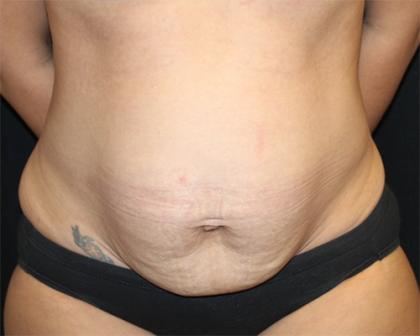 Tummy Tuck Before & After Patient #30027