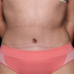 Tummy Tuck Before & After Patient #30027