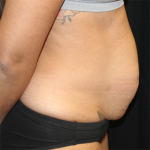 Tummy Tuck Before & After Patient #30027