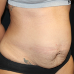 Tummy Tuck Before & After Patient #30027