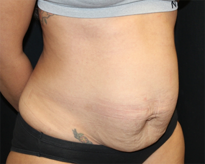 Tummy Tuck Before & After Patient #30027