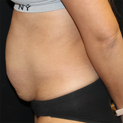 Tummy Tuck Before & After Patient #30027