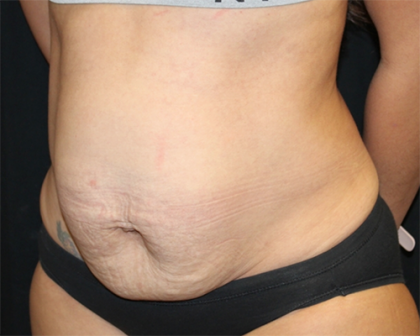 Tummy Tuck Before & After Patient #30027