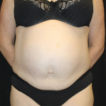 Tummy Tuck Before & After Patient #30039