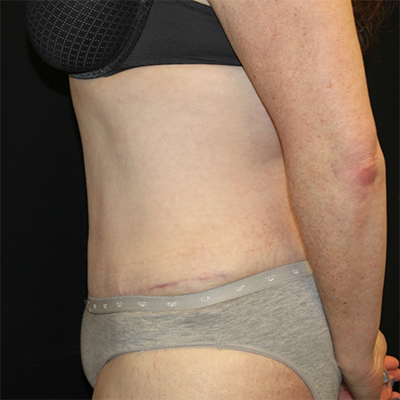 Tummy Tuck Before & After Patient #30039