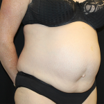 Tummy Tuck Before & After Patient #30039