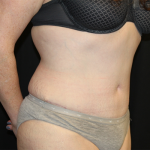 Tummy Tuck Before & After Patient #30039