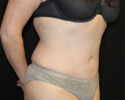 Tummy Tuck Before & After Patient #30039