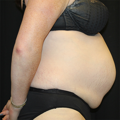 Tummy Tuck Before & After Patient #30039