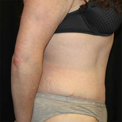 Tummy Tuck Before & After Patient #30039