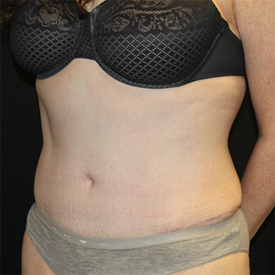 Tummy Tuck Before & After Patient #30039