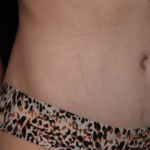 Tummy Tuck Before & After Patient #29949