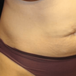 Tummy Tuck Before & After Patient #29949