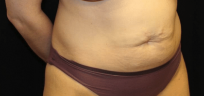 Tummy Tuck Before & After Patient #29949