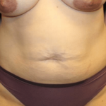 Tummy Tuck Before & After Patient #29949