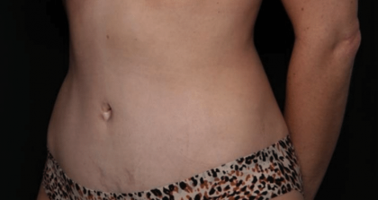 Tummy Tuck Before & After Patient #29949