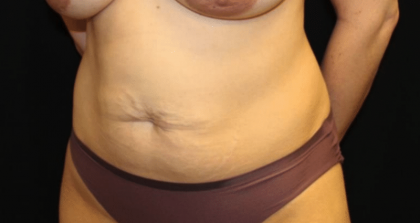 Tummy Tuck Before & After Patient #29949