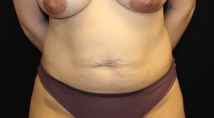 Tummy Tuck Before & After Patient #29949