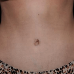 Tummy Tuck Before & After Patient #29949